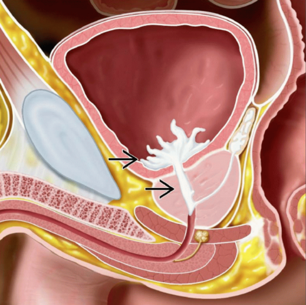 Retrograde Ejaculation